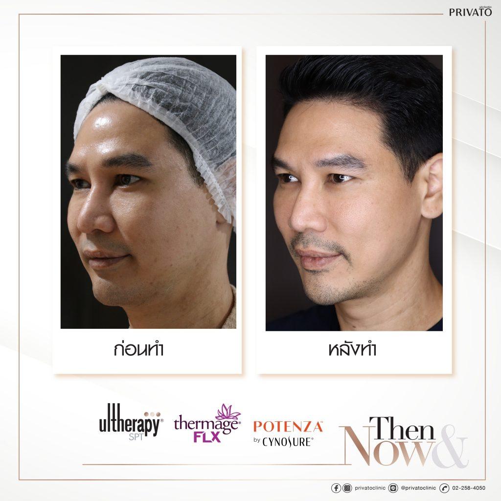 ผลลัพธ์การรักษาหน้าเหี่ยวด้วยโปรแกรมยกกระชับ Ulthera Thermage และ Potenza