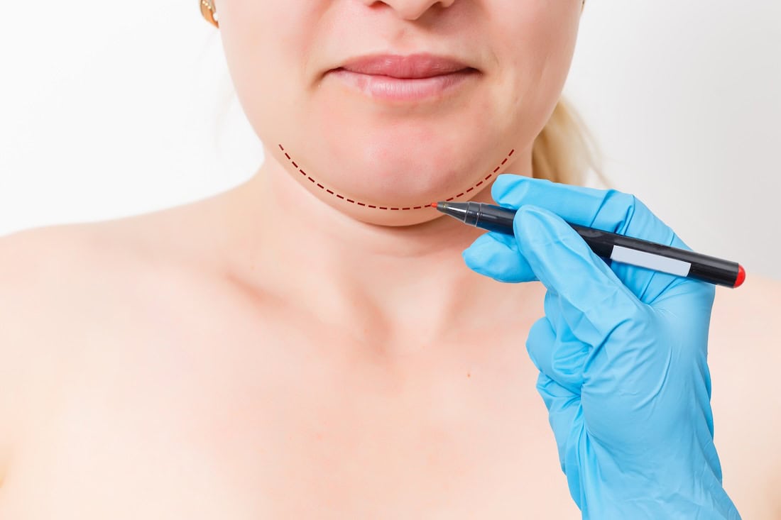 Methods to Fat Face Removal By Non-Surgical
