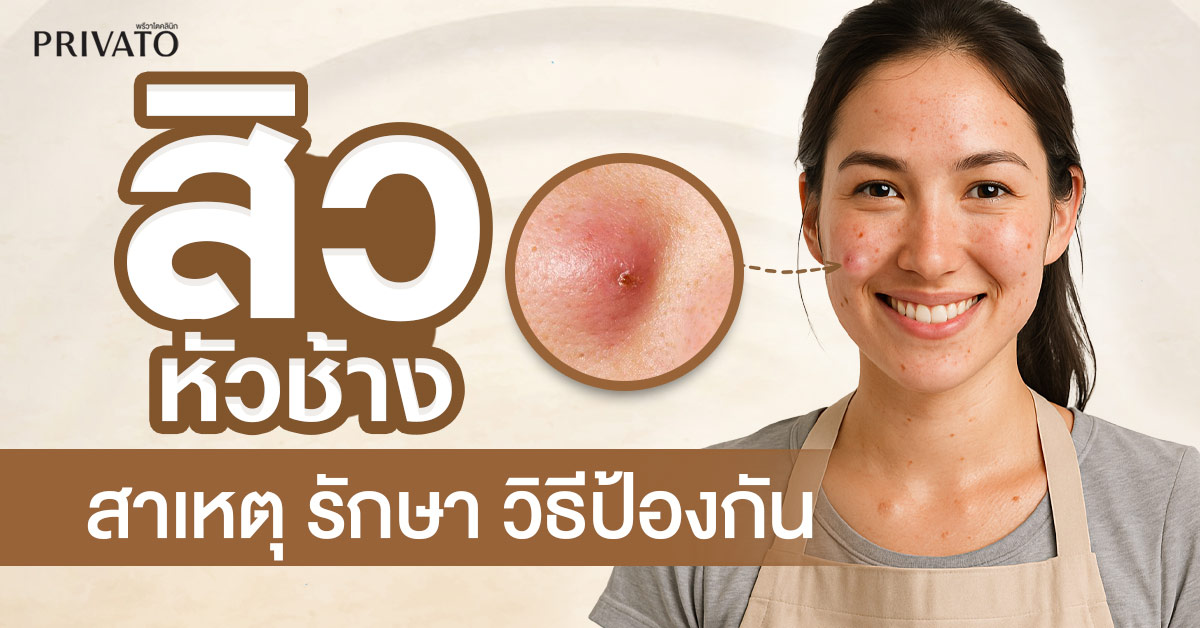 สิวหัวช้าง
