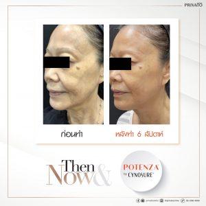 ผลลัพธ์การรักษาริ้วรอยด้วยโปรแกรมยกกระชับ Potenza