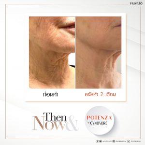 ผลลัพธ์การรักษาริ้วรอยด้วยโปรแกรมยกกระชับ Potenza