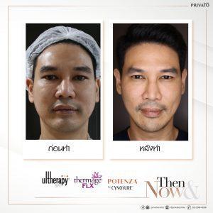 ผลลัพธ์การรักษาหน้าเหี่ยวด้วยโปรแกรมยกกระชับ Ulthera Thermage และ Potenza