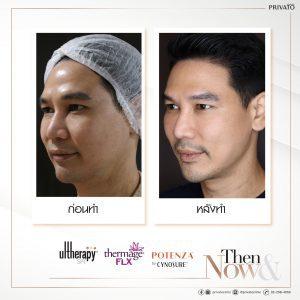 ผลลัพธ์การรักษาหน้าเหี่ยวด้วยโปรแกรมยกกระชับ Ulthera Thermage และ Potenza