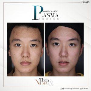 ผลลัพธ์การรักษาสิวด้วยโปรแกรม Magenta Light Plasma Photon