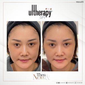 ผลลัพธ์การรักษาแก้มห้อยด้วยโปรแกรมยกกระชับ Ulthera
