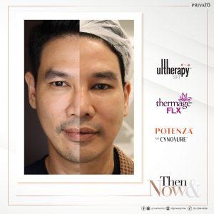 ผลลัพธ์การรักษาหน้าเหี่ยวด้วยโปรแกรมยกกระชับ Ulthera Thermage และ Potenza