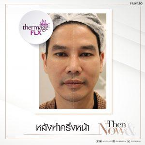 ผลลัพธ์การรักษาหน้าหย่อนคล้อยด้วยโปรแกรมยกกระชับ Thermage