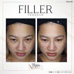 ผลลัพธ์การรักษาถุงใต้ตาด้วยฟิลเลอร์ Filler