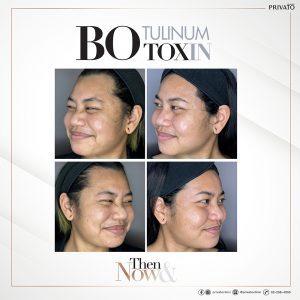 ผลลัพธ์การรักษาตีนกาด้วยโบ ท็อก Botox