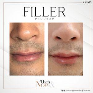 ผลลัพธ์การรักษาปากบางด้วยฟิลเลอร์ Filler