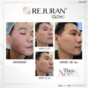 ผลลัพธ์การรักษาผิวแห้งรูขุมขนกว้างด้วยรีจูรัน Rejuran