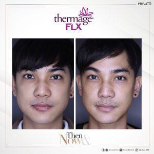 ผลลัพธ์การรักษาหน้าหย่อนคล้อยด้วยโปรแกรมยกกระชับ Thermage