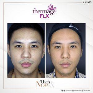 ผลลัพธ์การรักษาหน้าหย่อนคล้อยด้วยโปรแกรมยกกระชับ Thermage