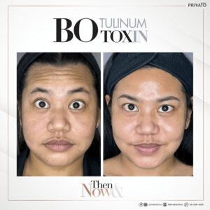 ผลลัพธ์การรักษาหน้าผาย่นด้วยโบ ท็อก Botox