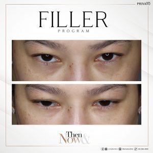ผลลัพธ์การรักษาถุงใต้ตาด้วยฟิลเลอร์ Filler