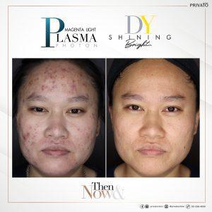 ผลลัพธ์การรักษารอยสิวด้วยโปรแกรมเลเซอร์ลบรอยแดง DY Shinning Bright