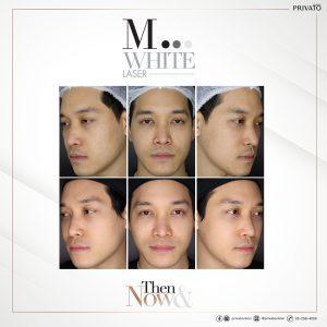 ผลลัพธ์การรักษาฝ้าจุดด่างดำด้วยโปรแกรมเลเซอร์ลบรอยดำ M White Laser