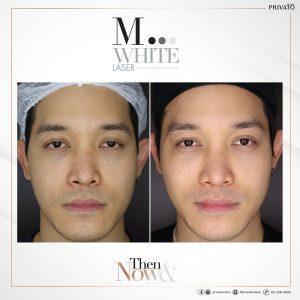 ผลลัพธ์การรักษาฝ้าจุดด่างดำด้วยโปรแกรมเลเซอร์ลบรอยดำ M White Laser