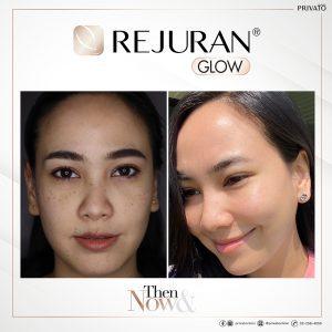 ผลลัพธ์การรักษาผิวแห้งรูขุมขนกว้างด้วยรีจูรัน Rejuran