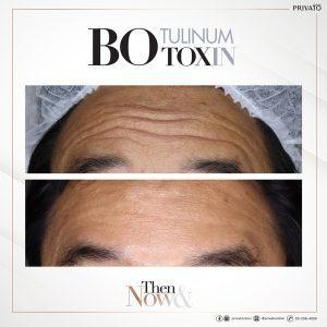 ผลลัพธ์การรักษาหน้าผาย่นด้วยโบ ท็อก Botox
