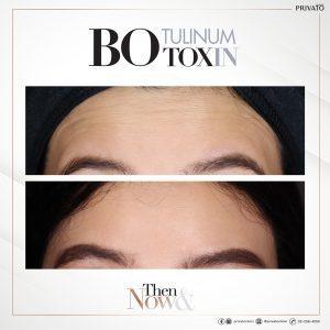 ผลลัพธ์การรักษาหน้าผาย่นด้วยโบ ท็อก Botox