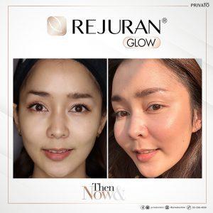 ผลลัพธ์การรักษาผิวแห้งรูขุมขนกว้างด้วยรีจูรัน Rejuran