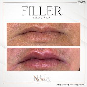 ผลลัพธ์การรักษาปากบางด้วยฟิลเลอร์ Filler