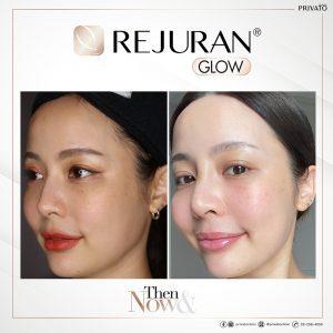 ผลลัพธ์การรักษาผิวแห้งรูขุมขนกว้างด้วยรีจูรัน Rejuran