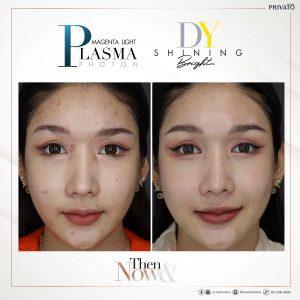 ผลลัพธ์การรักษารอยสิวด้วยโปรแกรมเลเซอร์ลบรอยแดง DY Shinning Bright
