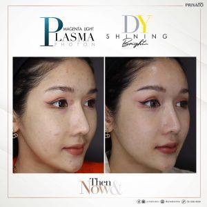 ผลลัพธ์การรักษารอยสิวด้วยโปรแกรมเลเซอร์ลบรอยแดง DY Shinning Bright