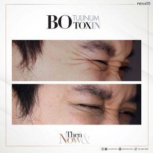 ผลลัพธ์การรักษาตีนกาด้วยโบ ท็อก Botox