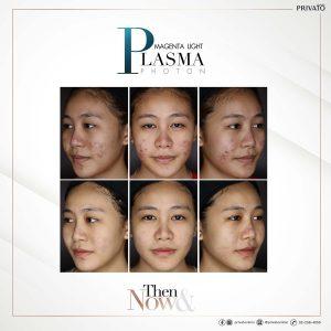 ผลลัพธ์การรักษาสิวด้วยโปรแกรม Magenta Light Plasma Photon