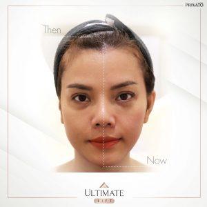 ผลลัพธ์การรักษาด้วยร่องแก้มลึกโปรแกรมยกกระชับ Ultimate Lift