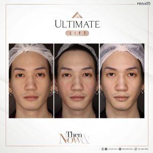 ผลลัพธ์การรักษาด้วยร่องแก้มลึกโปรแกรมยกกระชับ Ultimate Lift