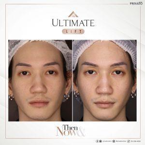 ผลลัพธ์การรักษาด้วยร่องแก้มลึกโปรแกรมยกกระชับ Ultimate Lift