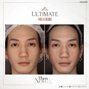ผลลัพธ์การรักษาด้วยร่องแก้มลึกโปรแกรมยกกระชับ Ultimate Lift