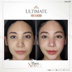 ผลลัพธ์การรักษาด้วยร่องแก้มลึกโปรแกรมยกกระชับ Ultimate Lift