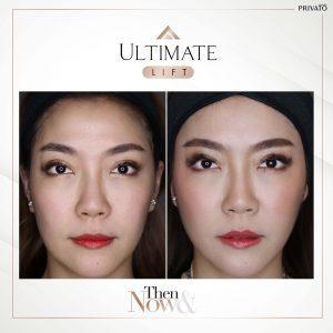 ผลลัพธ์การรักษาด้วยร่องแก้มลึกโปรแกรมยกกระชับ Ultimate Lift