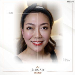 ผลลัพธ์การรักษาด้วยร่องแก้มลึกโปรแกรมยกกระชับ Ultimate Lift