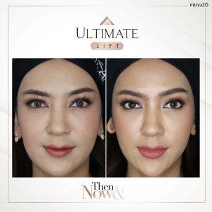 ผลลัพธ์การรักษาด้วยร่องแก้มลึกโปรแกรมยกกระชับ Ultimate Lift