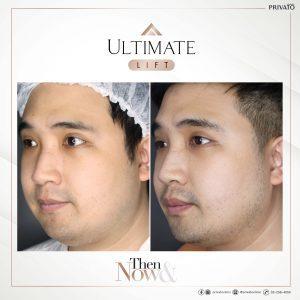 ผลลัพธ์การรักษาด้วยร่องแก้มลึกโปรแกรมยกกระชับ Ultimate Lift
