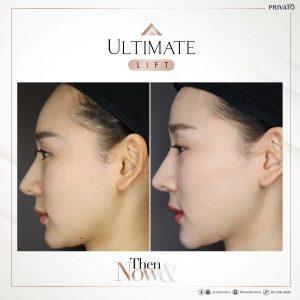 ผลลัพธ์การรักษาด้วยร่องแก้มลึกโปรแกรมยกกระชับ Ultimate Lift