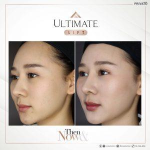ผลลัพธ์การรักษาด้วยร่องแก้มลึกโปรแกรมยกกระชับ Ultimate Lift