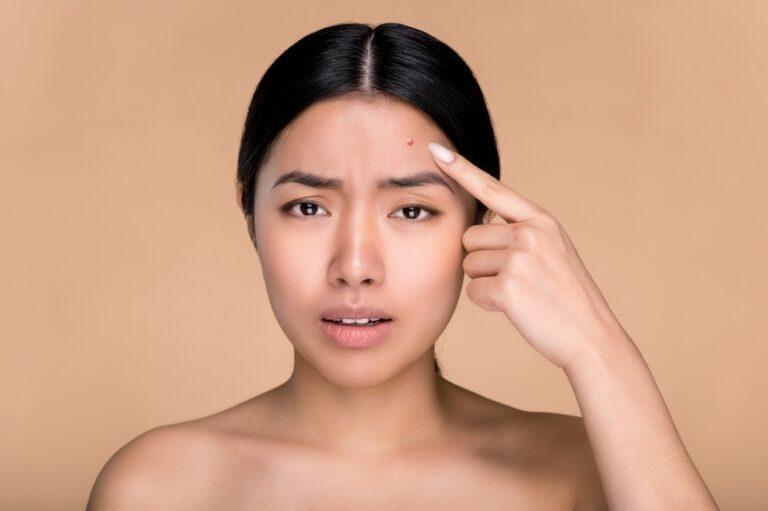 บอกลาปัญหา “สิวขึ้นหน้าผาก” เข้าใจสาเหตุและรักษาให้ตรงจุด