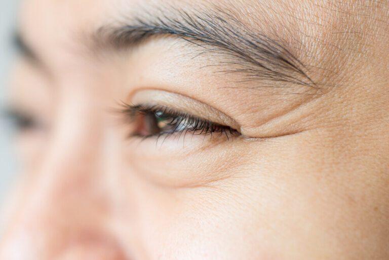 วิธีป้องกันและลบรอยตีนกาให้หน้าอ่อนเยาว์ ไร้ริ้วรอย