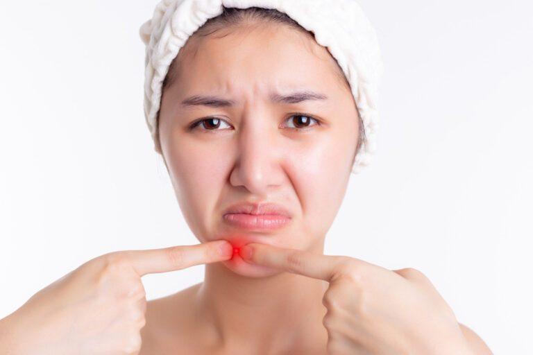 สิวที่คางเกิดจากอะไร รักษาอย่างไรให้ตรงจุด ?