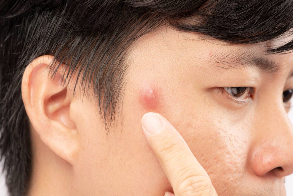 สิวหัวช้างเกิดจากอะไร แก้ไขยังไงให้หายดี
