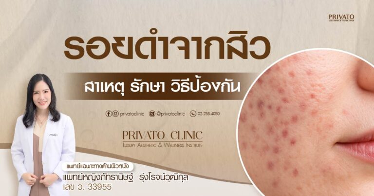 รอยดำจากสิว: สาเหตุ วิธีดูแล และการรักษาที่ได้ผล