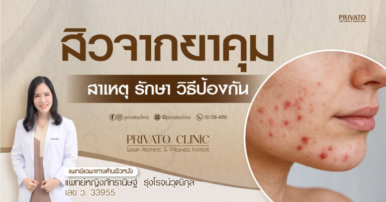 สิวจากยาคุม: สาเหตุ วิธีแก้ และคำแนะนำ