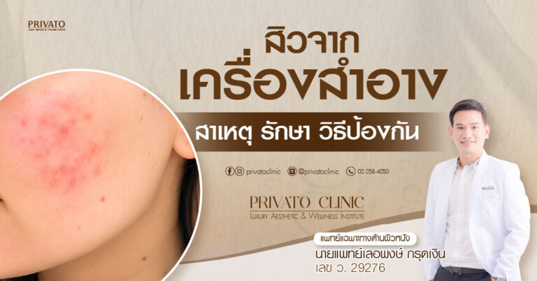 สิวจากเครื่องสำอาง: สาเหตุ การรักษา และการป้องกัน